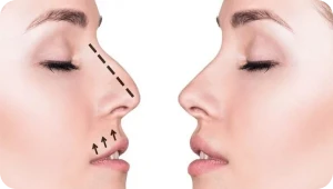 Soporte tratamiento Ácido Hialurónico (AH) 5 Rinomodelacion soporte